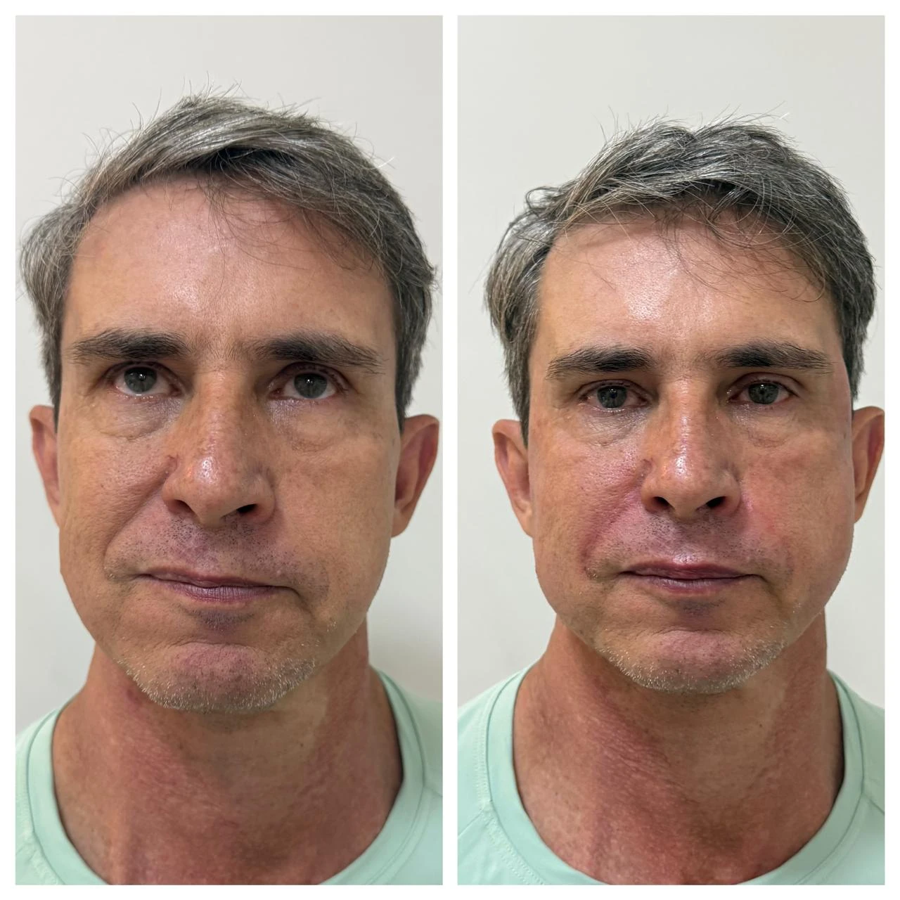 Comparativo de harmonização facial em paciente masculino
