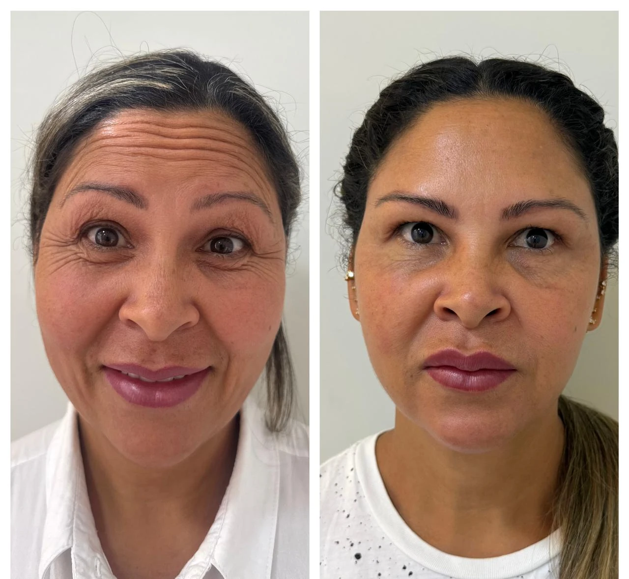 Comparativo frontal de rejuvenescimento facial