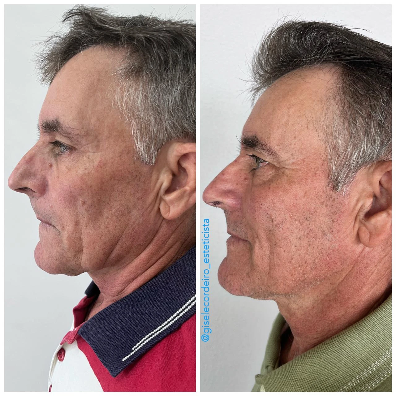 Comparativo lateral de rejuvenescimento facial em paciente masculino