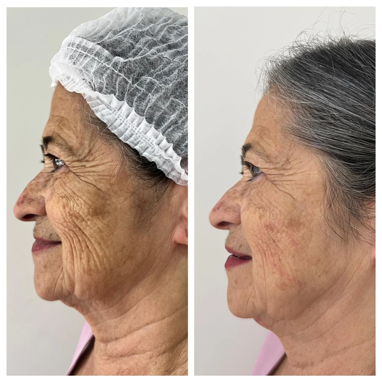 Comparativo lateral de rejuvenescimento facial em paciente idosa